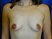 Breast Augmentation Before & After