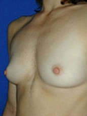 Breast Augmentation Before & After