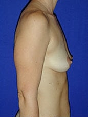 Breast Augmentation Before & After