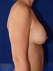 Breast Augmentation Before & After