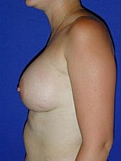 Breast Augmentation Before & After