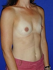 Breast Augmentation Before & After