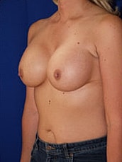 Breast Augmentation Before & After