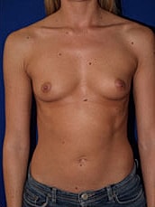 Breast Augmentation Before & After
