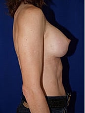 Breast Augmentation Before & After
