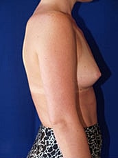 Breast Augmentation Before & After