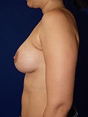 Breast Augmentation Before & After