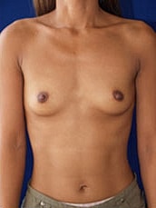 Breast Augmentation Before & After