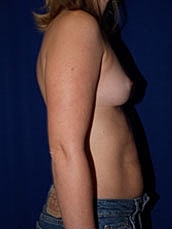 Breast Augmentation Before & After