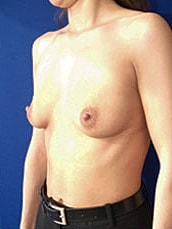 Breast Augmentation Before & After