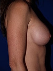 Breast Augmentation Before & After