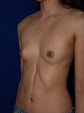 Breast Augmentation Before & After