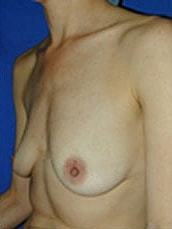 Breast Augmentation Before & After