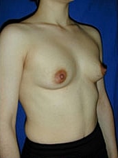 Breast Augmentation Before & After