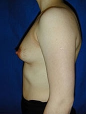 Breast Augmentation Before & After