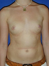 Breast Augmentation Before & After