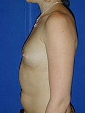 Breast Augmentation Before & After
