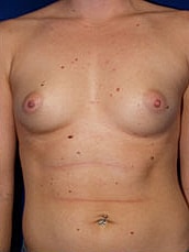 Breast Augmentation Before & After