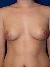 Breast Augmentation Before & After