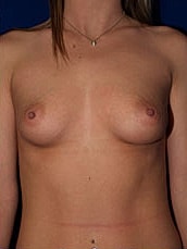Breast Augmentation Before & After