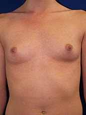 Breast Augmentation Before & After
