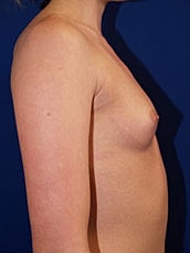 Breast Augmentation Before & After