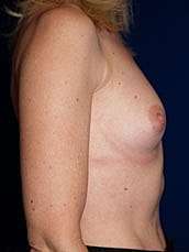 Breast Augmentation Before & After