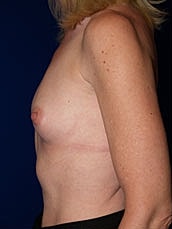 Breast Augmentation Before & After