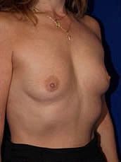 Breast Augmentation Before & After