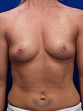 Breast Augmentation Before & After