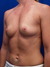 Breast Augmentation Before & After
