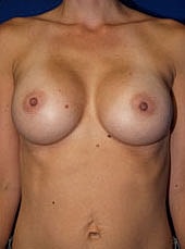 Breast Augmentation Before & After