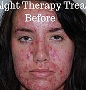Light Therapy Before & After