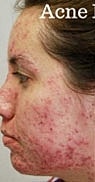 Light Therapy Before & After